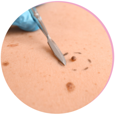 Removal of Warts and Pigmented Skin Lesions