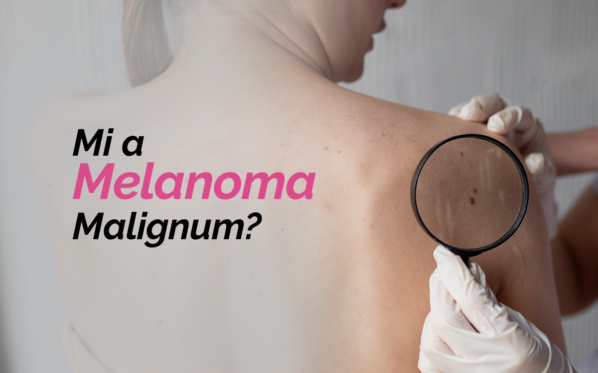 Mi a Melanoma Malignum?